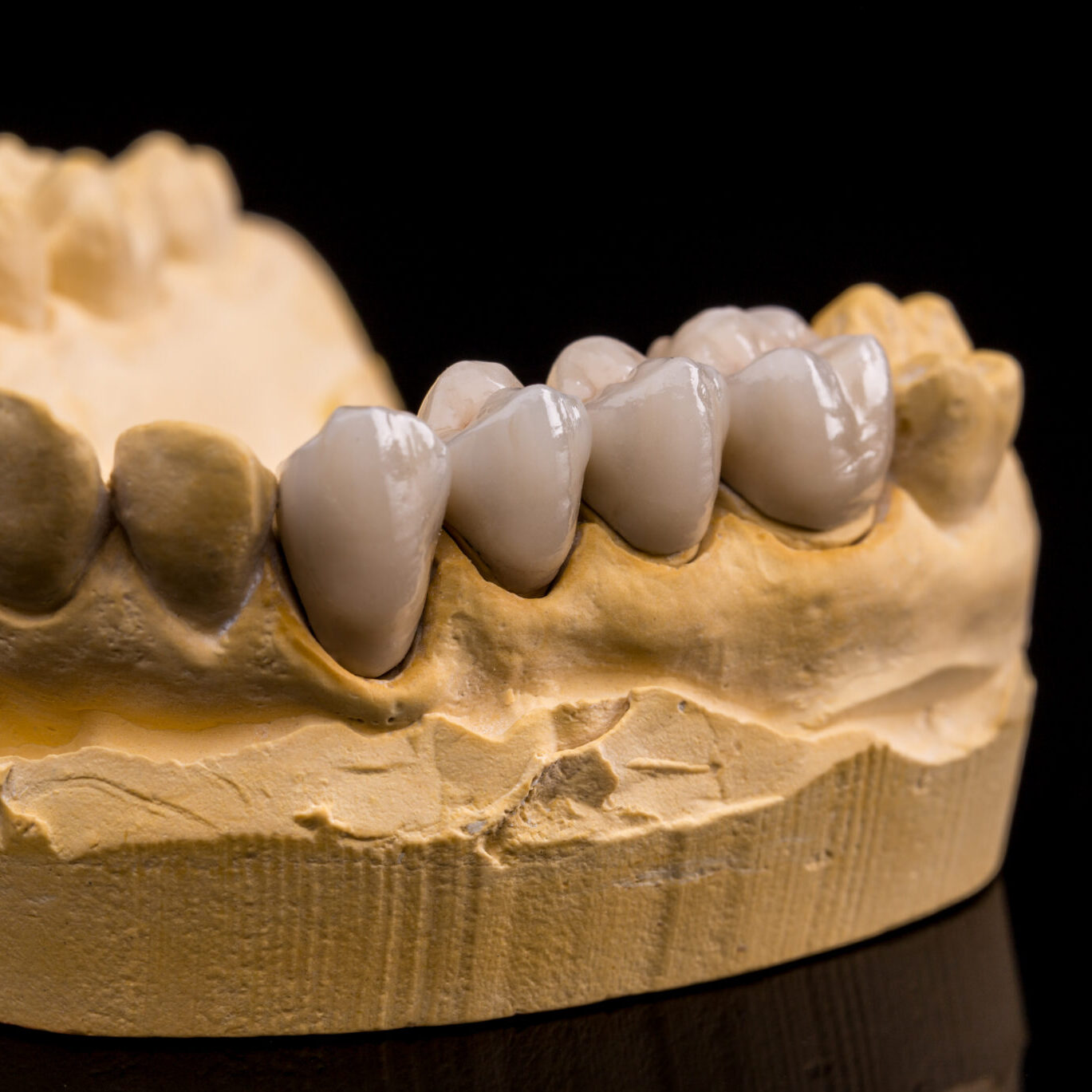 dental bridge ballarat ballarat dental bridge