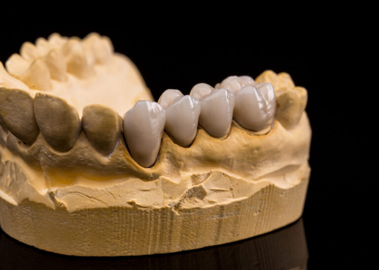 dental bridge ballarat ballarat dental bridge
